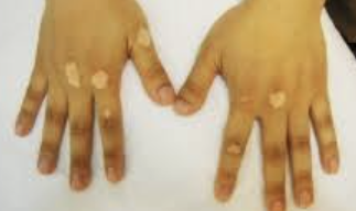 백반증 초기증상 28