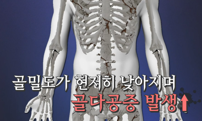골다공증