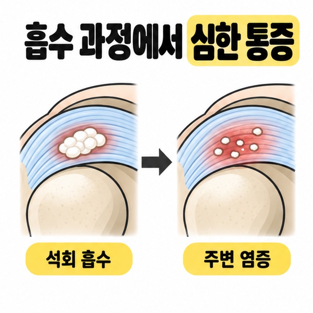 힘줄 안에 모여 있는 석회가 흩어진 모습과 주변의 붉은 염증 영역을 화살표로 연결한 비교 그림