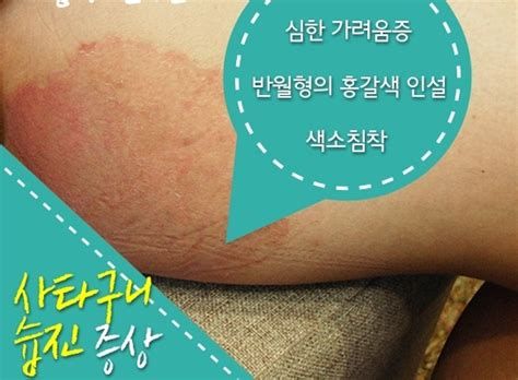 남자 사타구니 습진