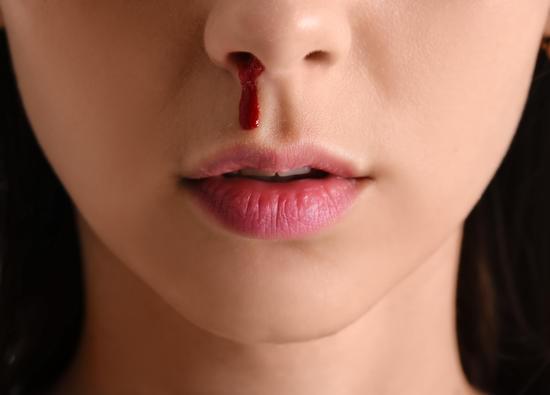 비출혈(Nosebleed): 원인, 진단, 치료