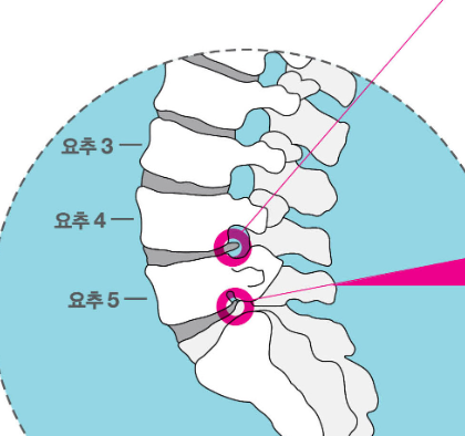 허리디스크 증상 2