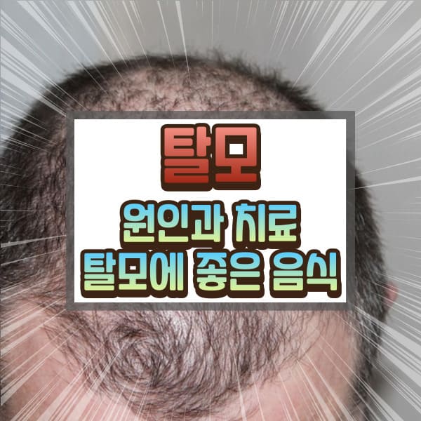 탈모 원인과 치료 탈모에 좋은 음식