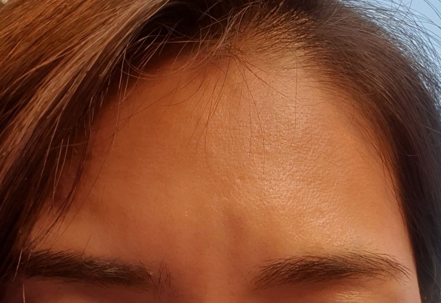 이마보톡스 후기