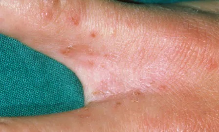 손가락 사이 옴 증상