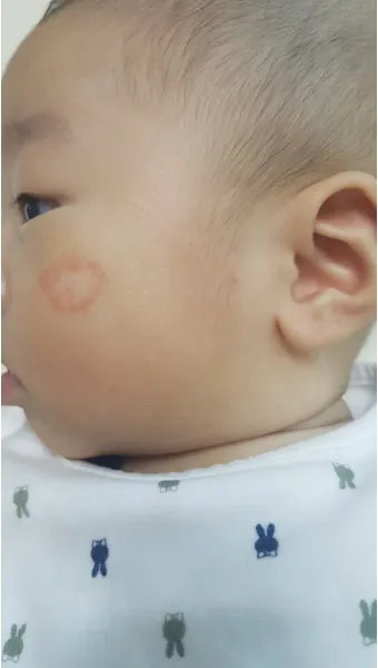 얼굴 버짐 증상 없애는 실전 방법 5가지 및 관리요령_24