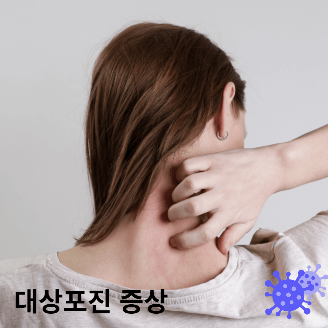대상포진 발병 사진