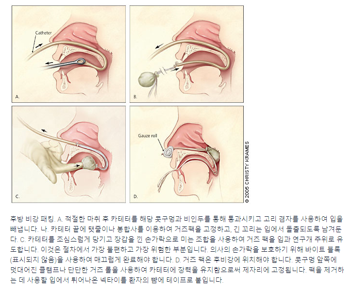 후방비강패킹