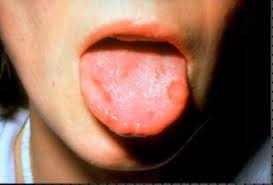 혓바늘 없애는 방법