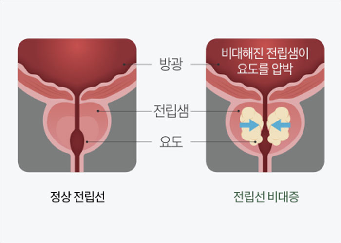카리토포텐 가격, 효능, 부작용