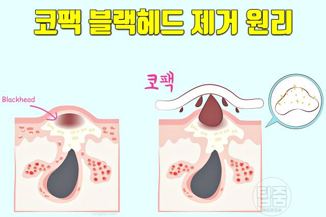 코팩 후 관리 코팩 모공 넓어짐 부작용 코팩추천