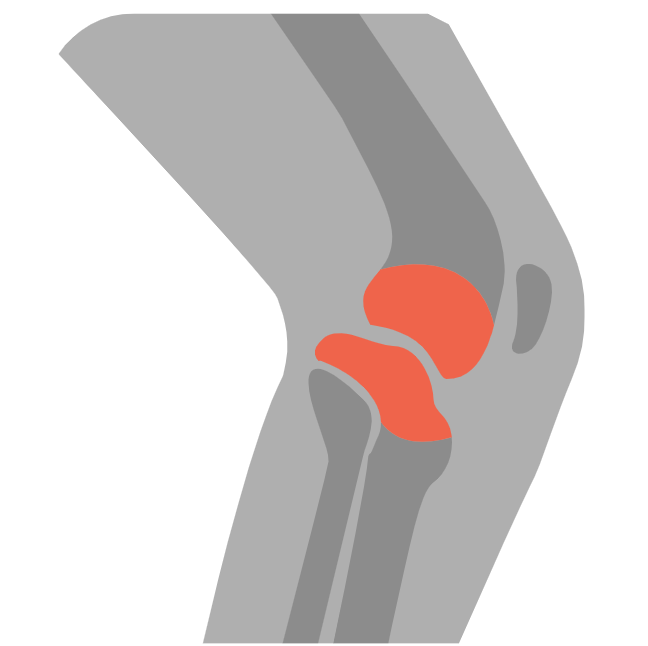 무릎 연골 찢어짐 증상 특징 단계별 재활 방법1