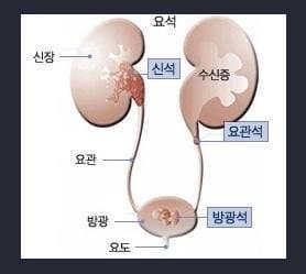 요로결석 증상