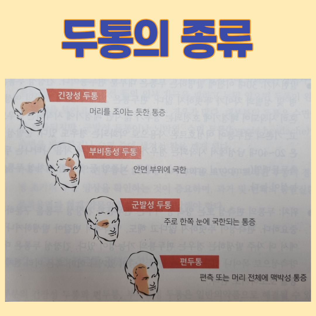 두통의 종류