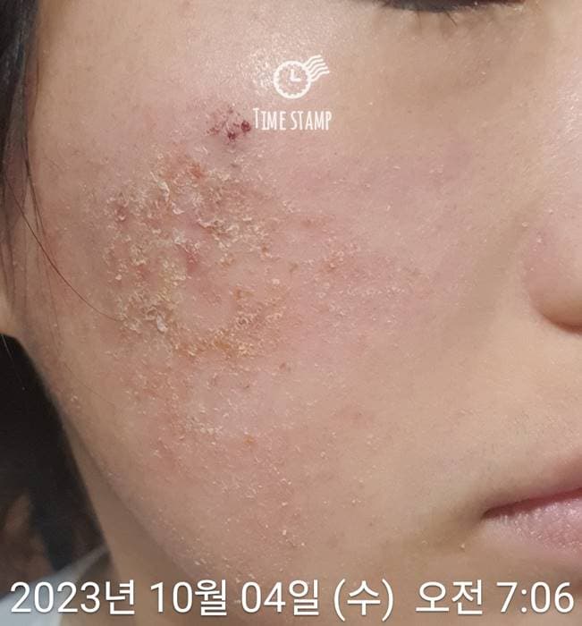 얼굴 피부염