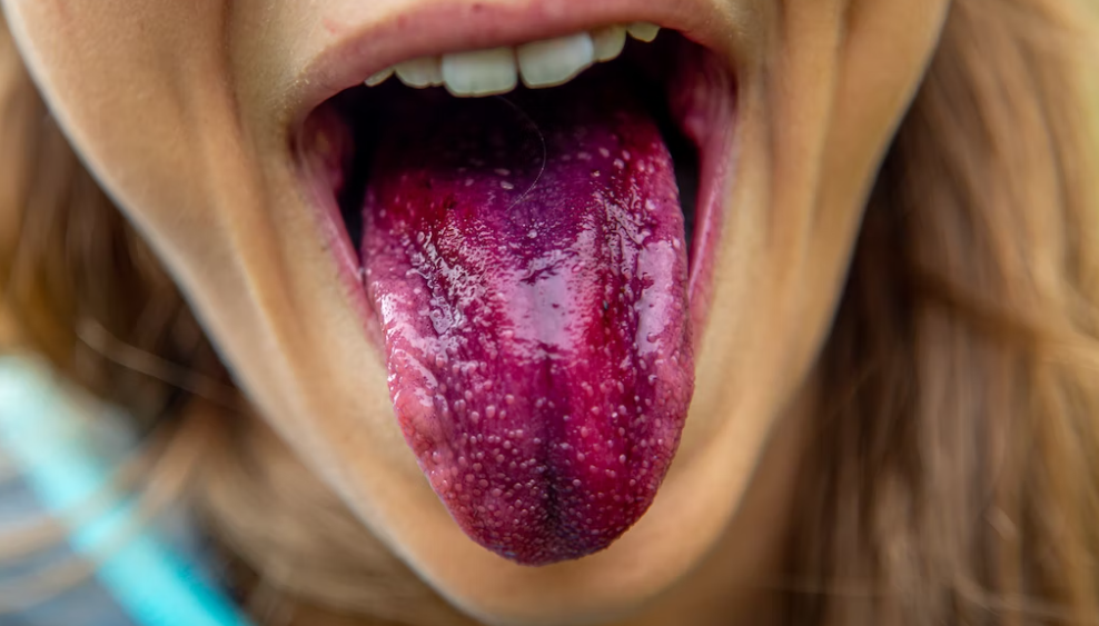 초기진단이 어려운 설암 초기증상 확인해 보아요