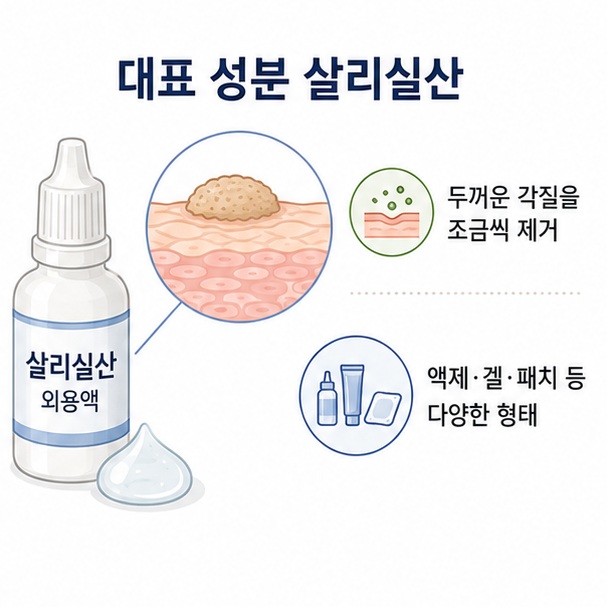 살리실산이 사마귀의 두꺼워진 각질층을 조금씩 제거하는 작용과 다양한 외용제 형태를 표현한 이미지