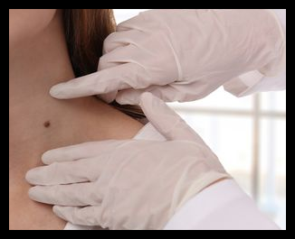 쥐젖 제거 크림