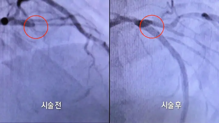 KBS 생로병사의 비밀 818회 급성 심근경색 심부전 협심증 심혈관 질환자를 위한 심장 재활 효과