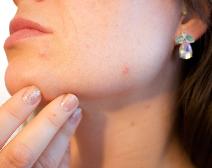 여드름 빨리 없애는 법 원인 증상