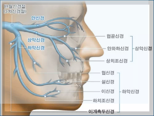 삼차 신경통