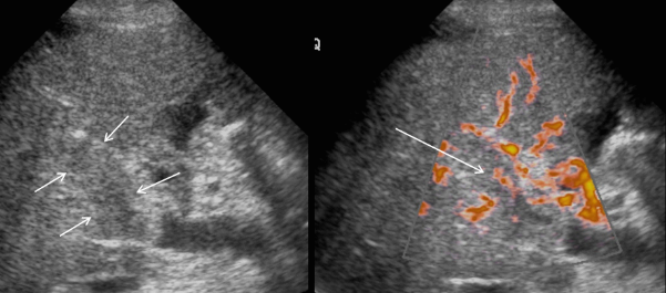 미만형 간세포암(diffuse type)