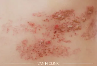 경기도 대상포진 무료접종 연령 기준 정리로 안내_6