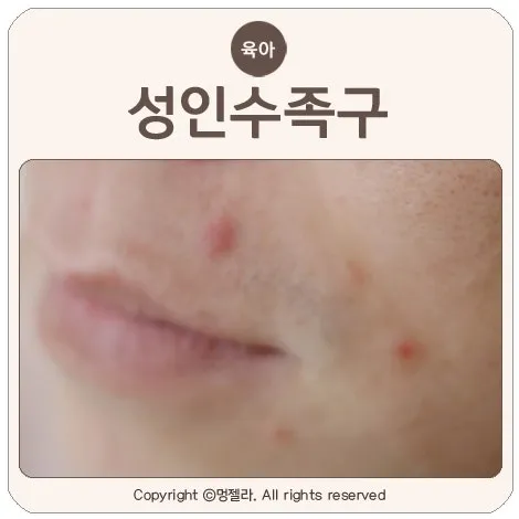 수족구 어른 전염에 대한 원인과 예방법 정리_5