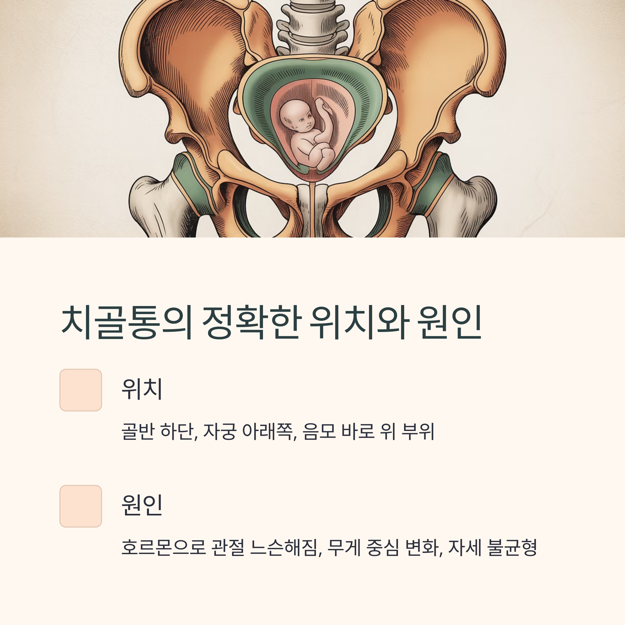 임산부의 골반과 태아 해부도를 통해 치골통 위치와 원인을 설명하는 인포그래픽