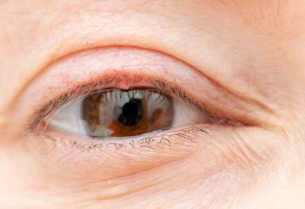 다래끼 약국약 마이노신 치료 효과와 다래끼 원인&amp;#44; 속다래끼 겉다래끼 어떻게 다른지 알아봐요 