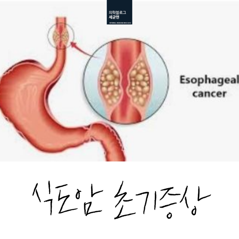 식도암