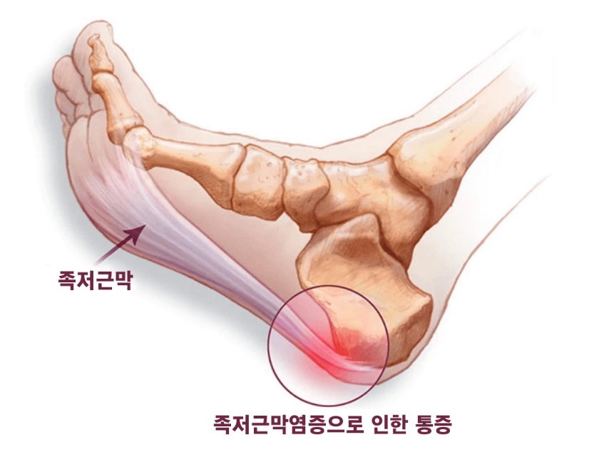 족저근막염-치료법