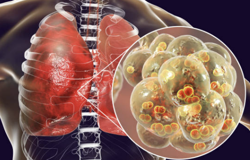 폐렴구균 예방접종 무료 시기