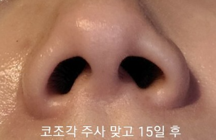 코조각주사 후기