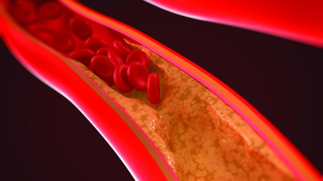 ldl 콜레스테롤 낮추는 방법
