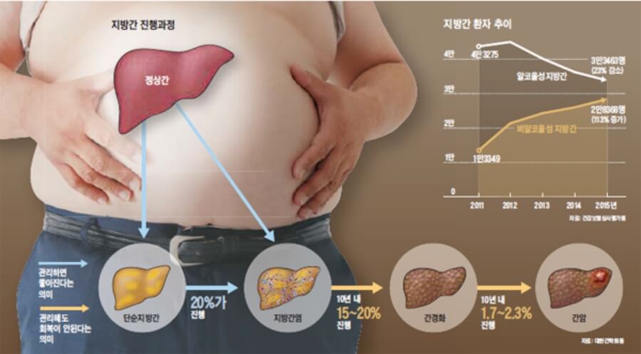 지방간 진행과정 이미지