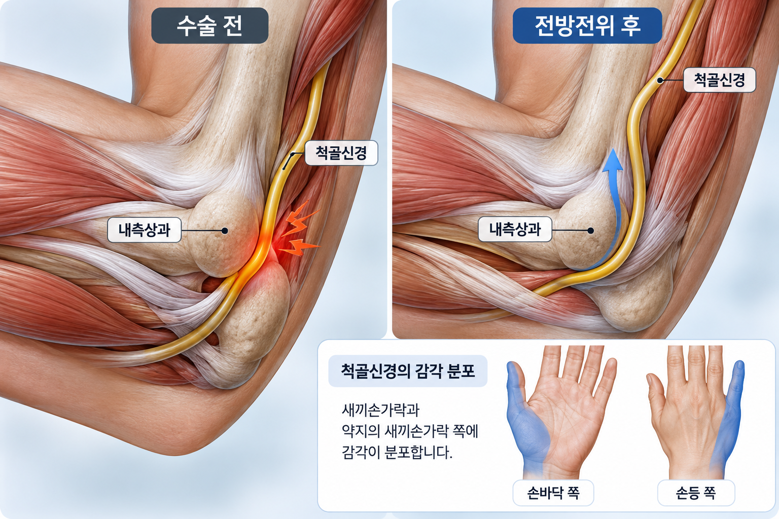 척골신경 전방전위술이란? 팔꿈치터널증후군 수술 방법과 회복 과정