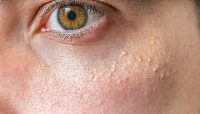 비립종 원인 생기는 이유 5가지 및 비립종 제거후 관리 Tip