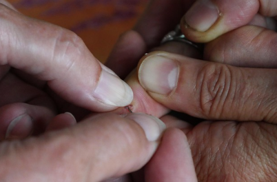 저온열기구 피부손상