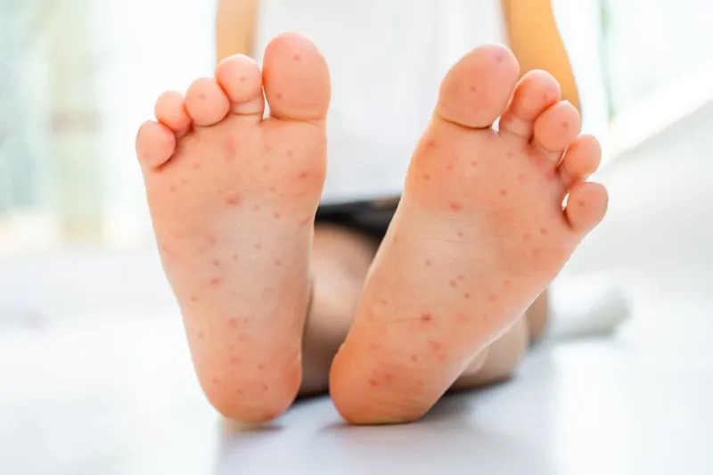 수족구 초기 증상 어른 감염 격리기간 예방 치료 완전 가이드_1