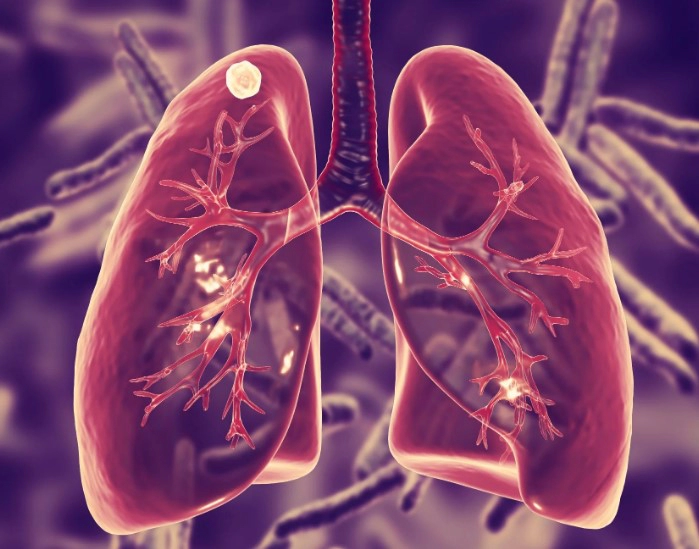 잠복결핵 검사 방법 보건소 병원 비용