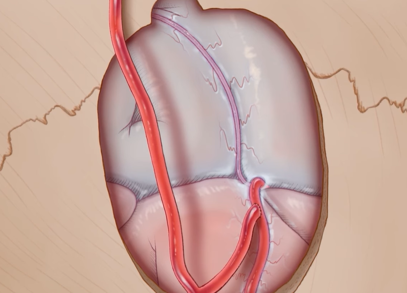 모야모야병 증상