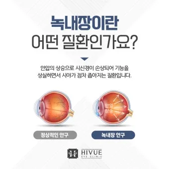 녹내장 진단 검사 비용 안압 검사주기 관리법_7