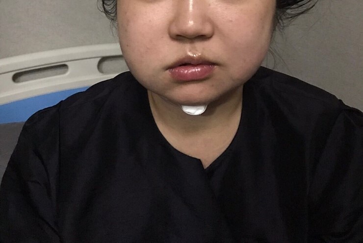 턱살지방흡입 후기