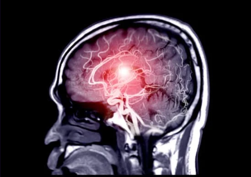 알츠하이머 초기증상 4가지와 대처방법 알아보기