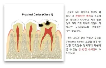 인레이 온레이의 차이와 치료 방법_18