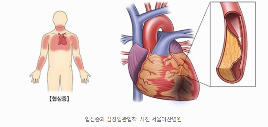 협심증 증상 초기부터 진행 단계까지 반드시 알아야 할 징후 정리