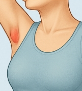 유방암 초기증상