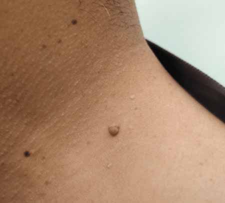 쥐젖 원인 제거 치료