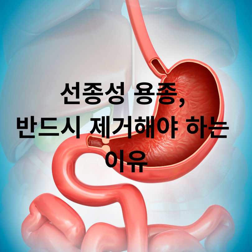 위 용종 암일확률? 걱정되는 분들을 위한 정확한 정보